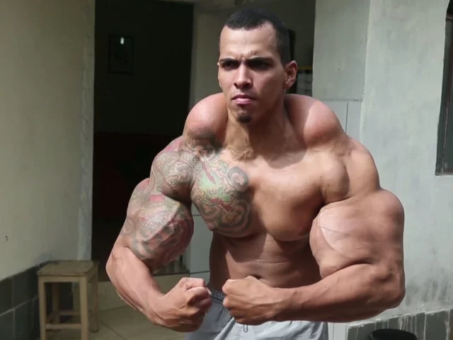 Il Synthol e i suoi effetti collaterali: la follia delle follie nel bodybuilding